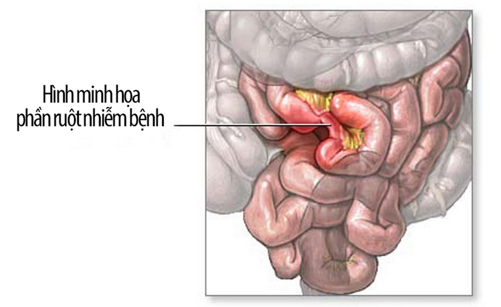 small-bowel-resection-series-2_resize