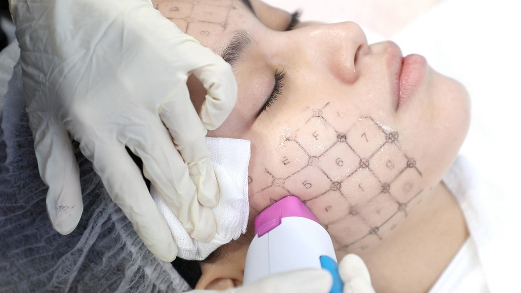 tiêm filler điều trị căng da mặt