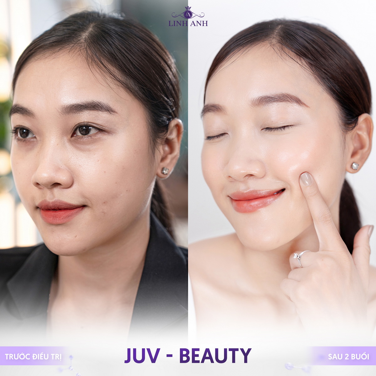 JUV-Beauty - Công nghệ trẻ hóa độc quyền tại Thẩm mỹ Quốc Tế Linh Anh