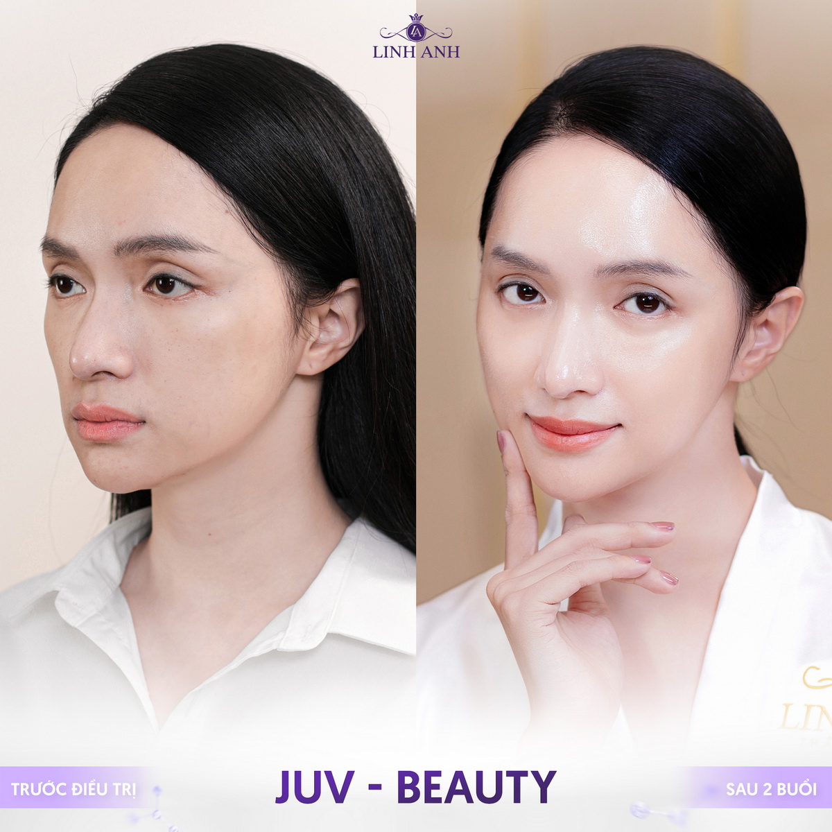 JUV-Beauty - Công nghệ trẻ hóa độc quyền tại Thẩm mỹ Quốc Tế Linh Anh