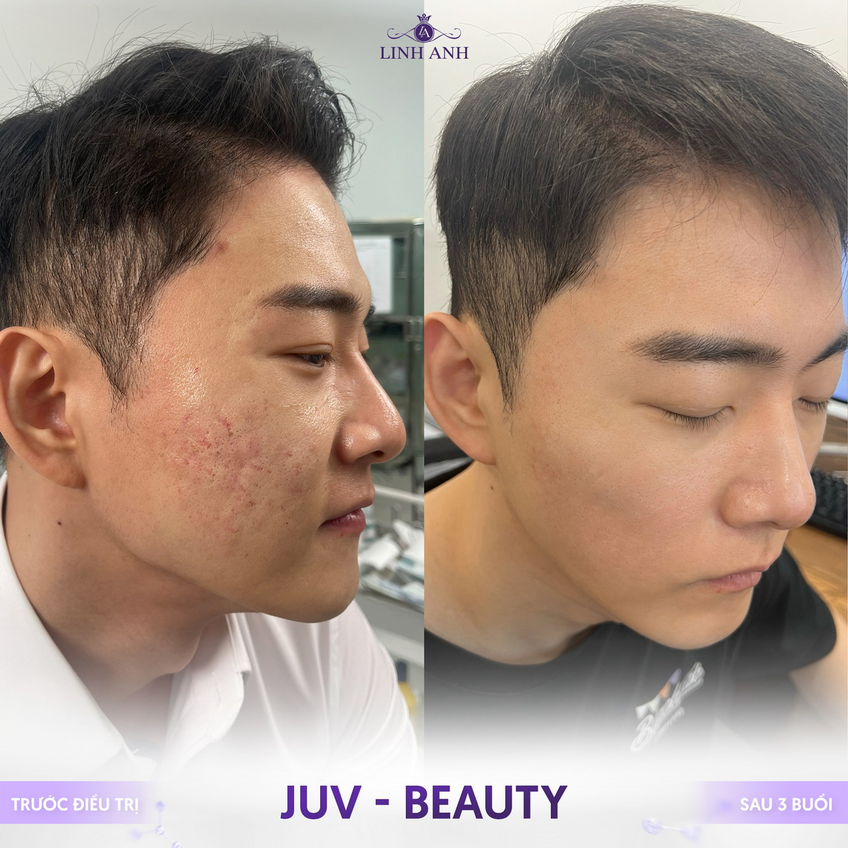 JUV-Beauty - Công nghệ trẻ hóa độc quyền tại Thẩm mỹ Quốc Tế Linh Anh